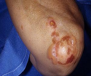 герпетиформный дерматит дюринга фото