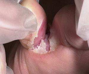 грибок стопы фото симптомы лечение