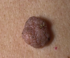 папилломатозный невус фото