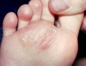 эпидермофития стоп фото