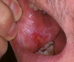 красный плоский лишай во рту фото