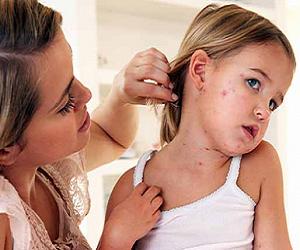 корь у детей симптомы и лечение фото