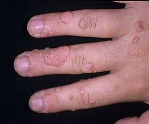 плоские бородавки на руках фото