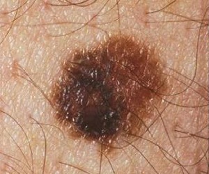 удаление невуса диспластического