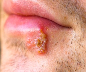 герпес на губах лечение фото