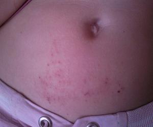 контактный дерматит симптомы и лечение фото