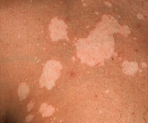 лишай у детей симптомы и лечение фото