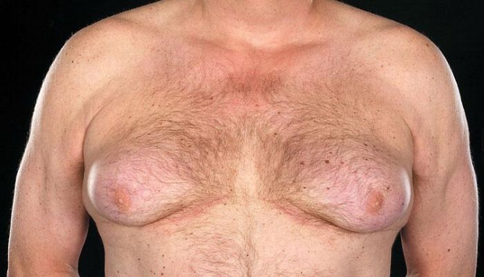 Увеличение грудных желез