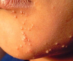 контагиозный моллюск у детей лечение