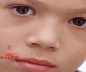 пиодермия у детей фото