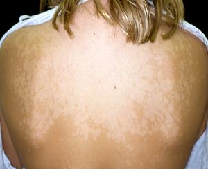 солнечный лишай фото у человека