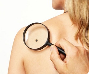 как выглядит рак кожи