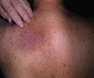 нейродермит симптомы и лечение фото