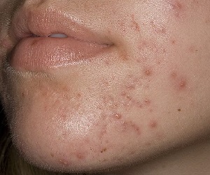 средство от следов от прыщей на лице