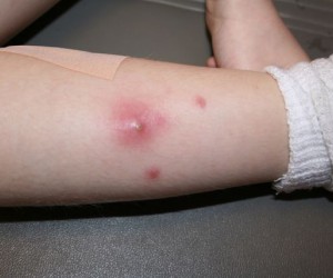 фурункулез фото