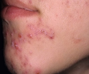 болючие прыщи на подбородке