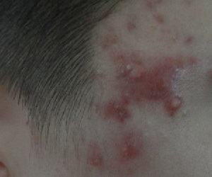 почему появляются прыщи на висках