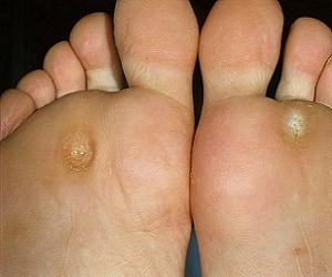 стержневая мозоль причины фото