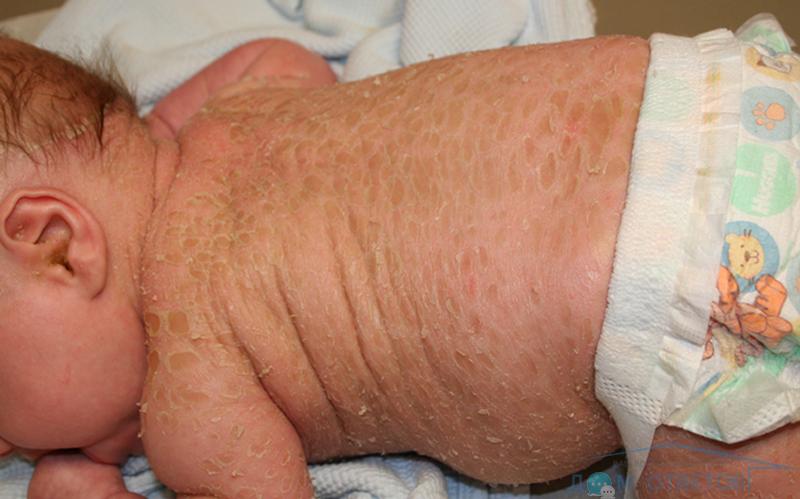 Ихтиоз у малыша