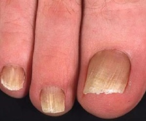 микоз ногтей фото