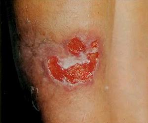 туберкулез кожи фото