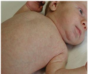 розеола у детей симптомы и лечение фото