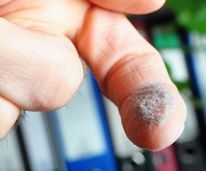 аллергия на пыль фото