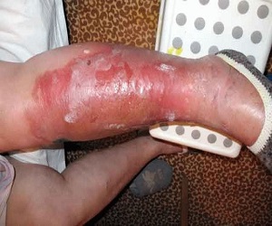 рожа на ноге фото