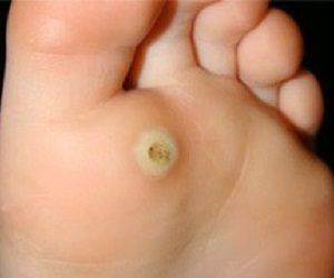 натоптыши фото на подошве лечение