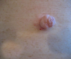 фиброма кожи фото