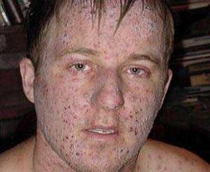 ветрянка у взрослых фото