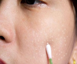 милиумы фото