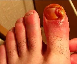 ноготь врос в палец