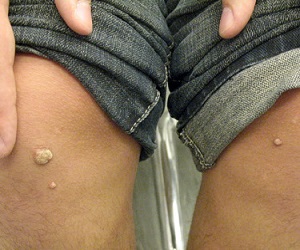 вирус папилломы человека у мужчин фото