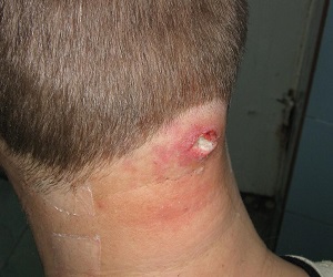 фурункул карбункул