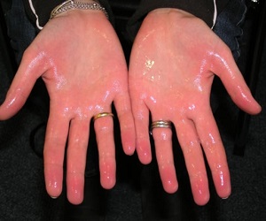 гипергидроз фото