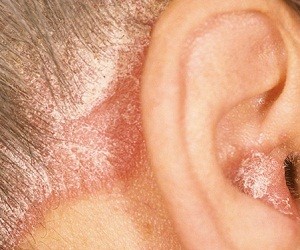 чем лечить псориаз волосистой части головы фото