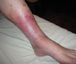 экзема на ногах фото начальная стадия