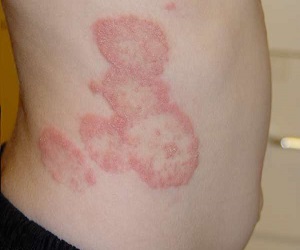 дерматомикоз симптомы и лечение фото