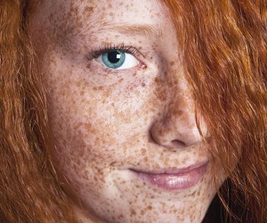 как избавиться от веснушек на лице