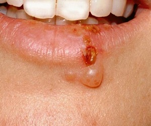 лечение герпеса при беременности