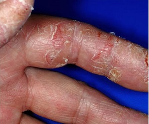 сухая экзема фото