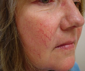 сосудистые звездочки фото