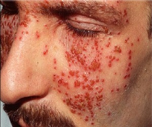 экзема на лице лечение