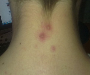 о чем говорят прыщи на шее