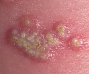 как выглядит генитальный герпес фото