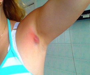 прыщи под мышкой фото