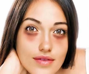 как вывести синяки под глазами