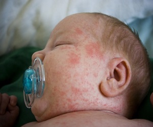 прыщи у новорожденного на лице и голове