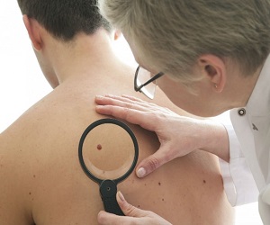 фото опасных родинок на теле